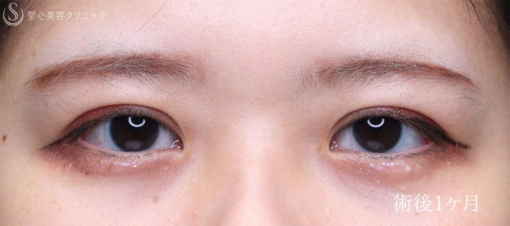 【20代女性・お目元をスッキリ可愛く仕上げます】二重術（切開法）部分切開/全切開（術後直後～1ヶ月） After 