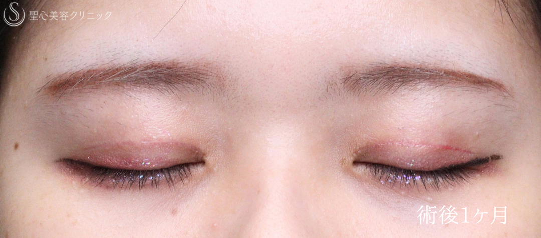 【20代女性・お目元をスッキリ可愛く仕上げます】二重術（切開法）部分切開/全切開（術後直後～1ヶ月） After 