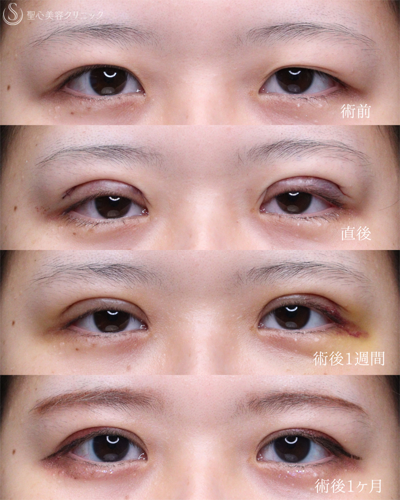 【20代女性・お目元をスッキリ可愛く仕上げます】二重術（切開法）部分切開/全切開（術後直後～1ヶ月） After 