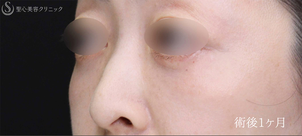 【40代女性・目のクマをスッキリ解消】下眼瞼切開術/下眼瞼除皺術/ハムラ法（術後1週間～3ヶ月） After 