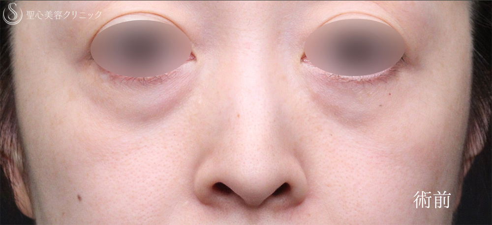 【40代女性・目のクマをスッキリ解消】下眼瞼切開術/下眼瞼除皺術/ハムラ法（術後1週間～3ヶ月） Before 