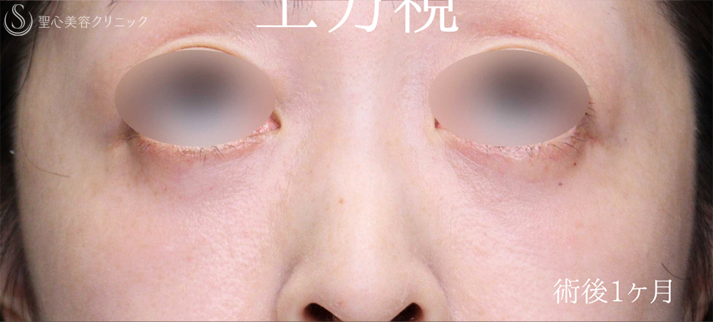 【40代女性・目のクマをスッキリ解消】下眼瞼切開術/下眼瞼除皺術/ハムラ法（術後1週間～3ヶ月） After 