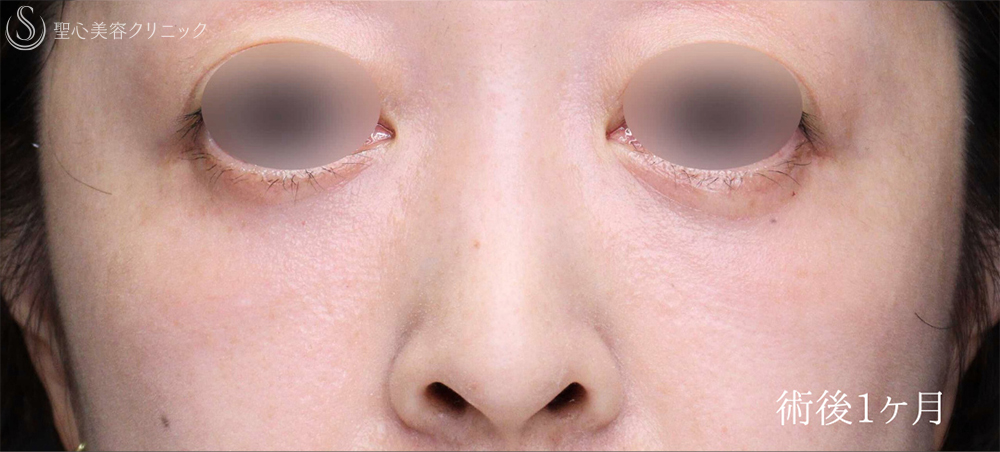 【40代女性・目のクマをスッキリ解消】下眼瞼切開術/下眼瞼除皺術/ハムラ法（術後1週間～3ヶ月） After 