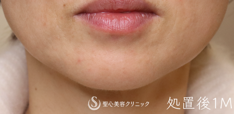 【50代女性・アゴの梅干ジワを改善】ボトックス注射（術後1ヶ月） After 