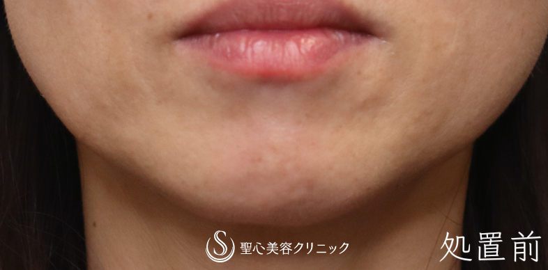【50代女性・アゴの梅干ジワを改善】ボトックス注射（術後1ヶ月） Before 