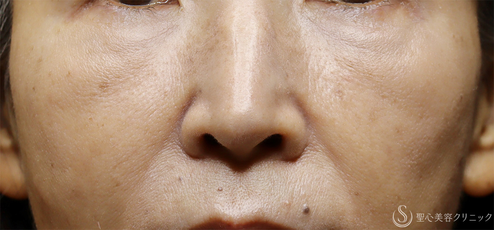 【60代女性・肌育で若返り】プレミアムPRP皮膚再生療法（4年後） After 