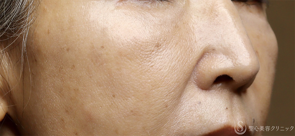 【60代女性・肌育で若返り】プレミアムPRP皮膚再生療法（4年後） After 