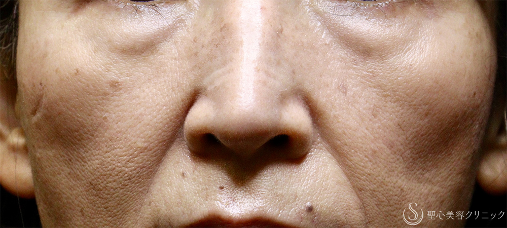 【60代女性・肌育で若返り】プレミアムPRP皮膚再生療法（4年後） Before 