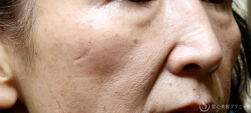 【60代女性・肌育で若返り】プレミアムPRP皮膚再生療法（4年後） Before 