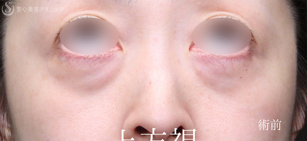 【40代女性・目のクマをスッキリ解消】下眼瞼切開術/下眼瞼除皺術/ハムラ法（術後1週間～3ヶ月） Before 