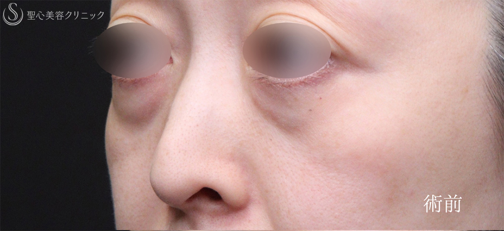 【40代女性・目のクマをスッキリ解消】下眼瞼切開術/下眼瞼除皺術/ハムラ法（術後1週間～3ヶ月） Before 