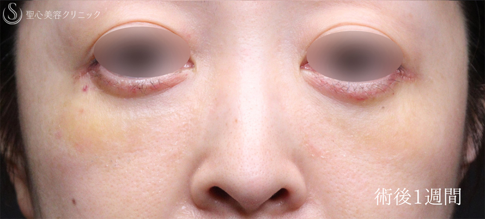 【40代女性・目のクマをスッキリ解消】下眼瞼切開術/下眼瞼除皺術/ハムラ法（術後1週間～3ヶ月） After 