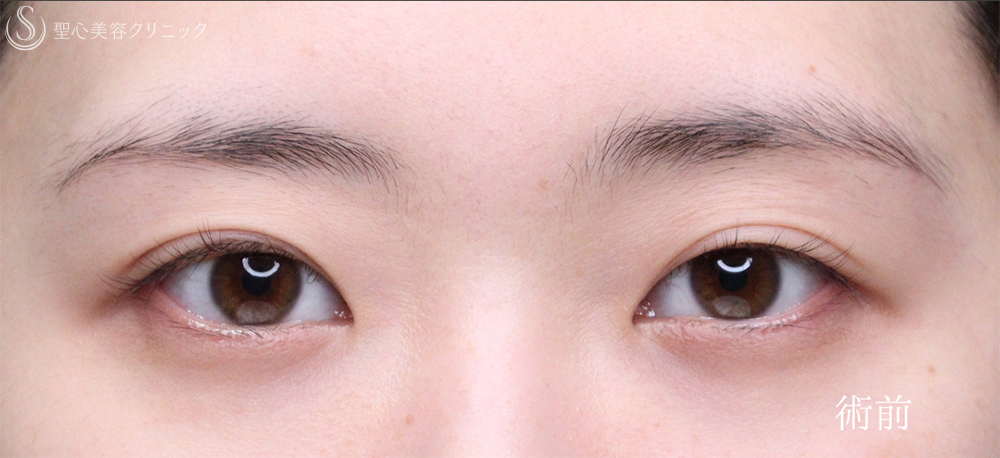 【20代女性・目を閉じても自然さをキープ】二重術（切開法）部分切開/全切開（術後1ヶ月） Before 