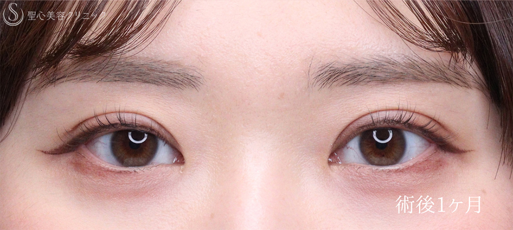【20代女性・目を閉じても自然さをキープ】二重術（切開法）部分切開/全切開（術後1ヶ月） After 