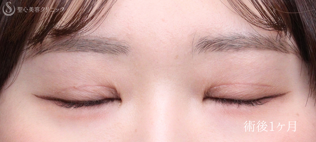 【20代女性・目を閉じても自然さをキープ】二重術（切開法）部分切開/全切開（術後1ヶ月） After 