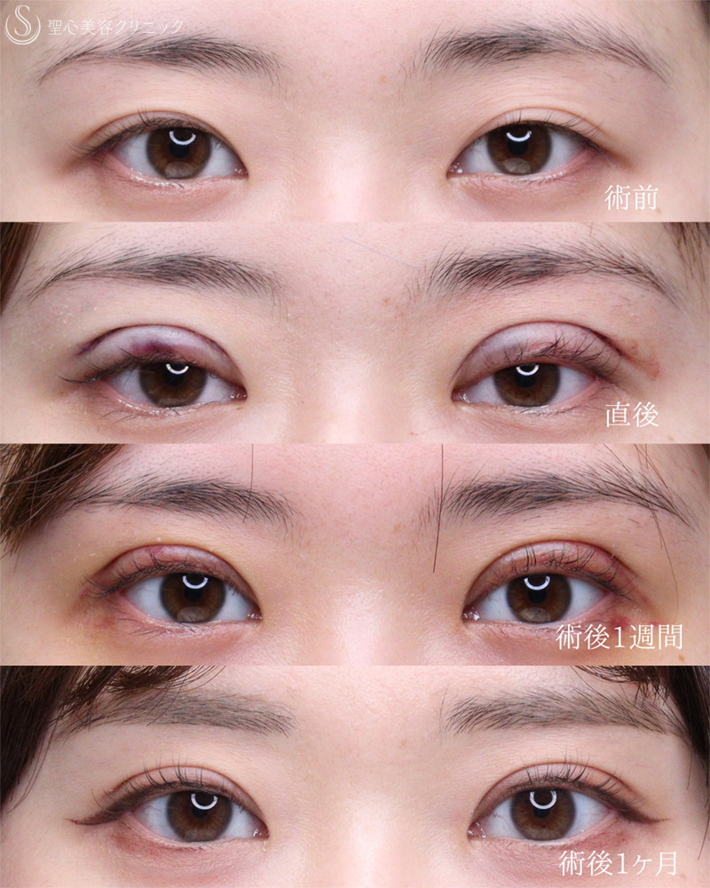 【20代女性・目を閉じても自然さをキープ】二重術（切開法）部分切開/全切開（術後1ヶ月） After 