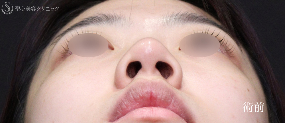 【20代女性・忘れ鼻に】小鼻縮小（術後1ヶ月） Before 