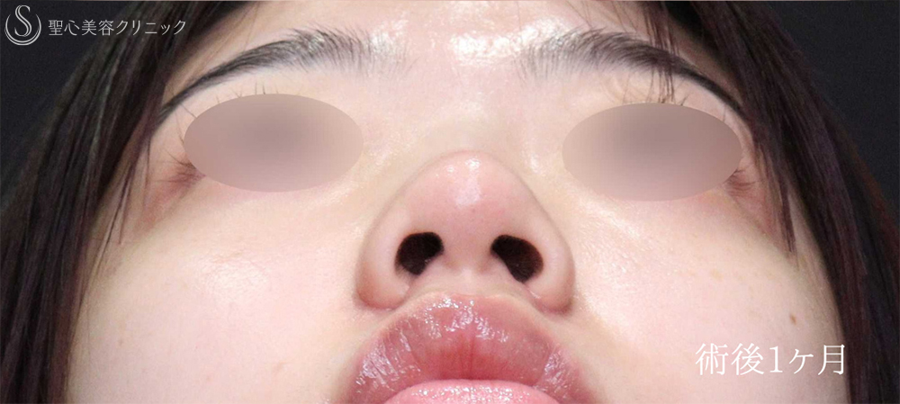 【20代女性・忘れ鼻に】小鼻縮小（術後1ヶ月） After 