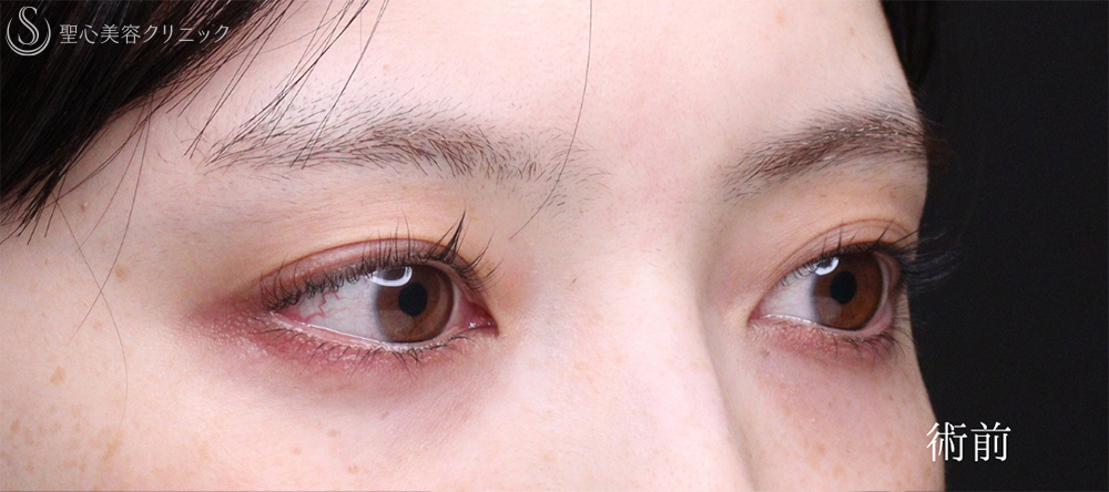 【20代女性・くっきり平行二重に】二重術（埋没法）：マイクロメソッド+α（術後1ヶ月） Before 