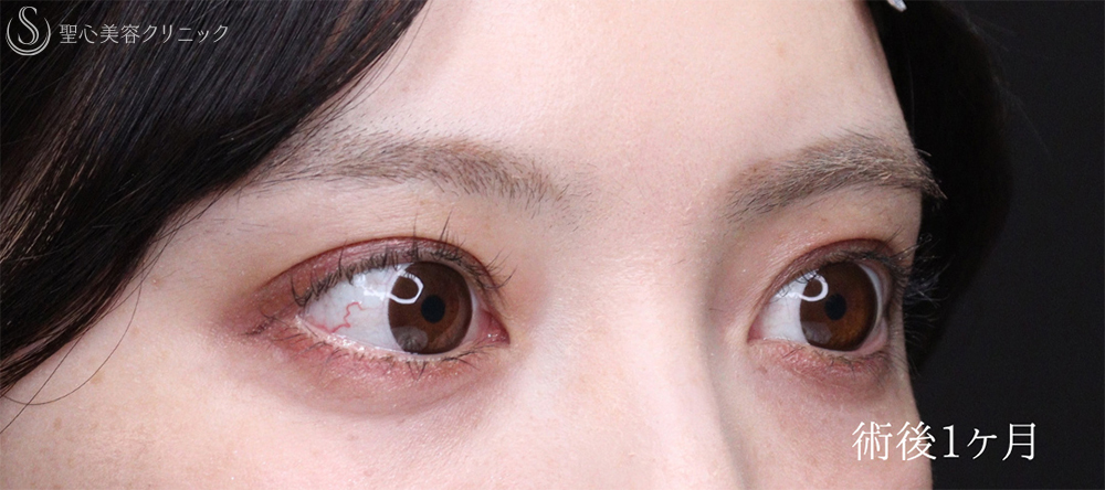【20代女性・くっきり平行二重に】二重術（埋没法）：マイクロメソッド+α（術後1ヶ月） After 