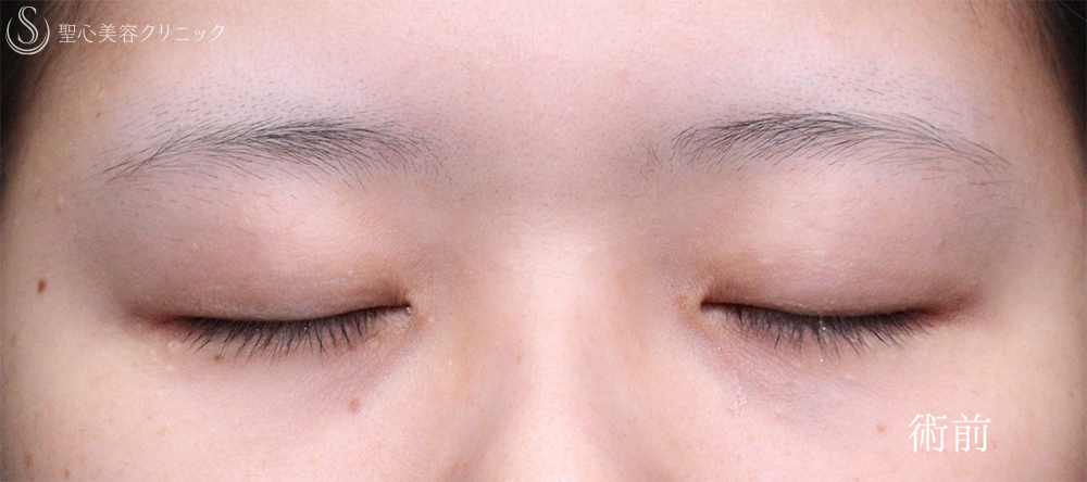 【20代女性・お目元をスッキリ可愛く仕上げます】二重術（切開法）部分切開/全切開（術後直後～1ヶ月） Before 