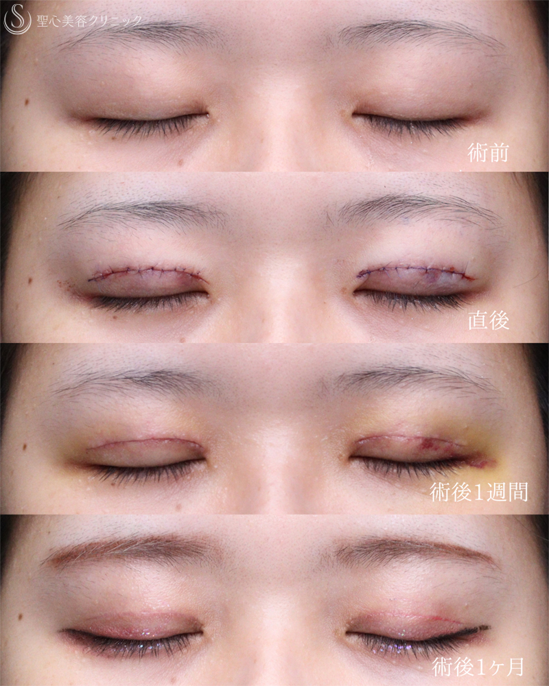 【20代女性・お目元をスッキリ可愛く仕上げます】二重術（切開法）部分切開/全切開（術後直後～1ヶ月） After 