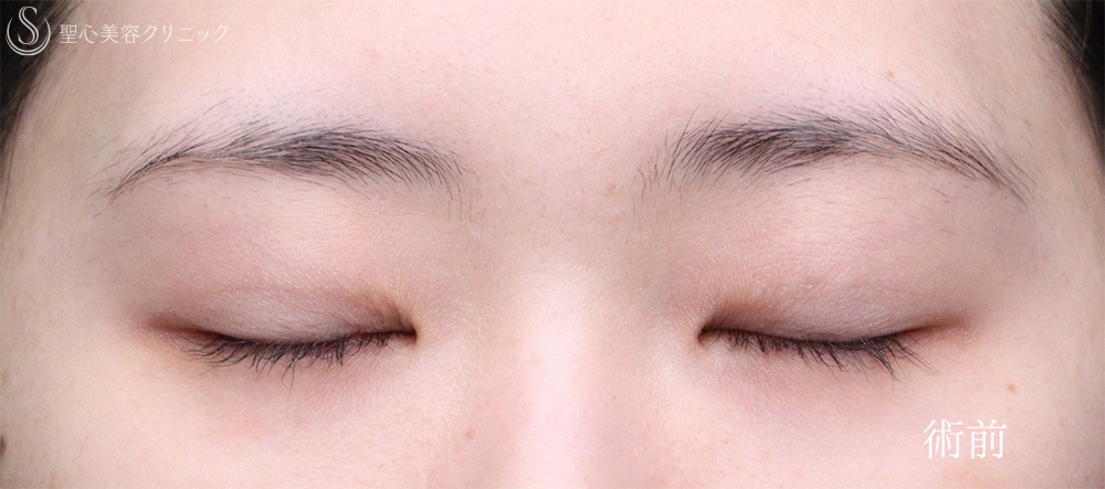 【20代女性・目を閉じても自然さをキープ】二重術（切開法）部分切開/全切開（術後1ヶ月） Before 