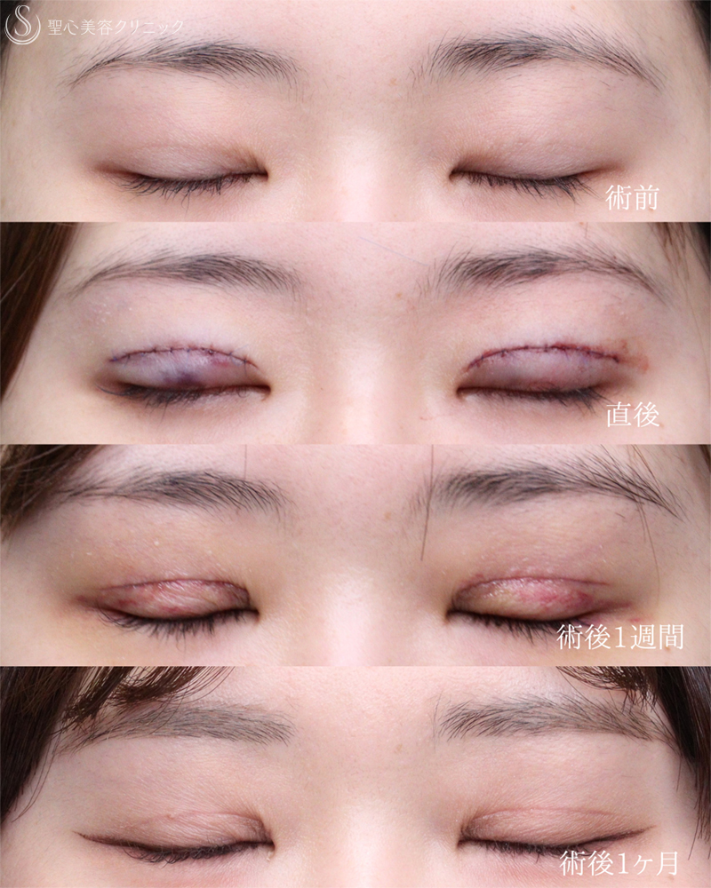 【20代女性・目を閉じても自然さをキープ】二重術（切開法）部分切開/全切開（術後1ヶ月） After 