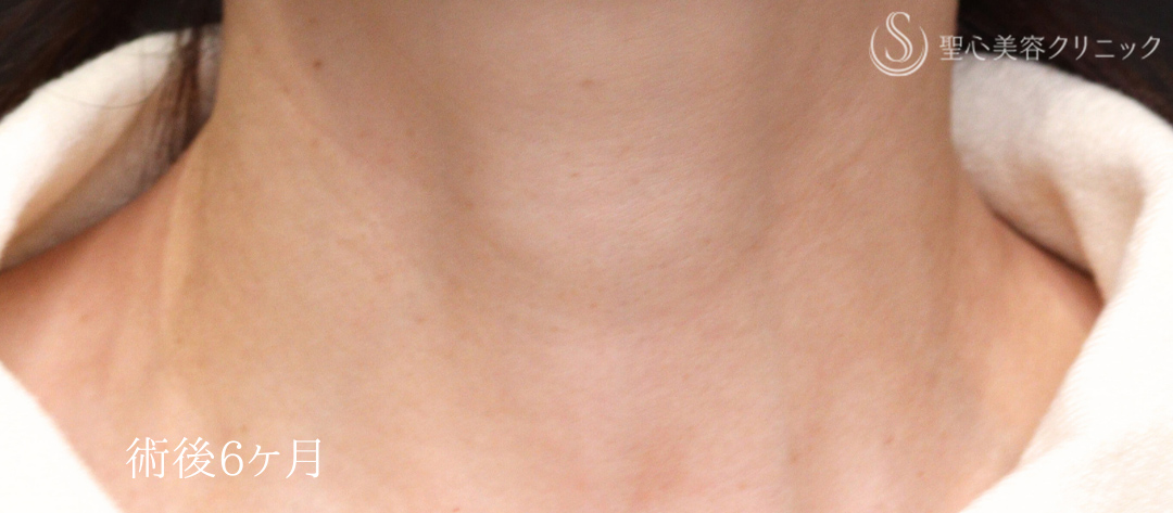 【40代女性・首の横しわが改善】プレミアムPRP皮膚再生療法（術後6ヶ月） After 
