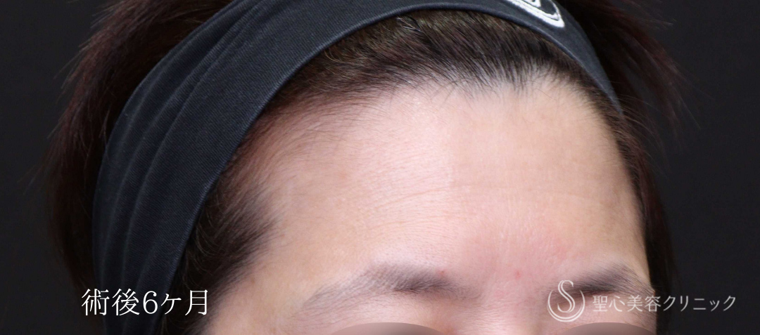 【40代女性・額のはり、凹みをPRPで改善】プレミアムPRP皮膚再生療法（術後6ヶ月） After 