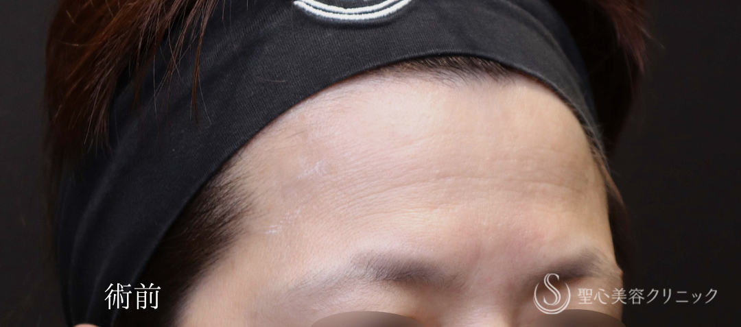 【40代女性・額のはり、凹みをPRPで改善】プレミアムPRP皮膚再生療法（術後6ヶ月） Before 