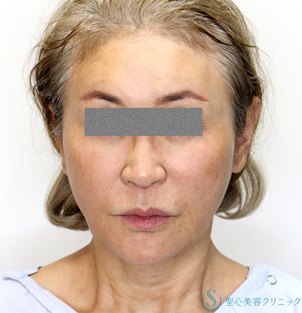【60代女性・頬～顎下のたるみ・膨らみの改善】フェイスリフト（Low SMAS三角弁法modified）＋ 頬脂肪吸引（1ヶ月後） Before 