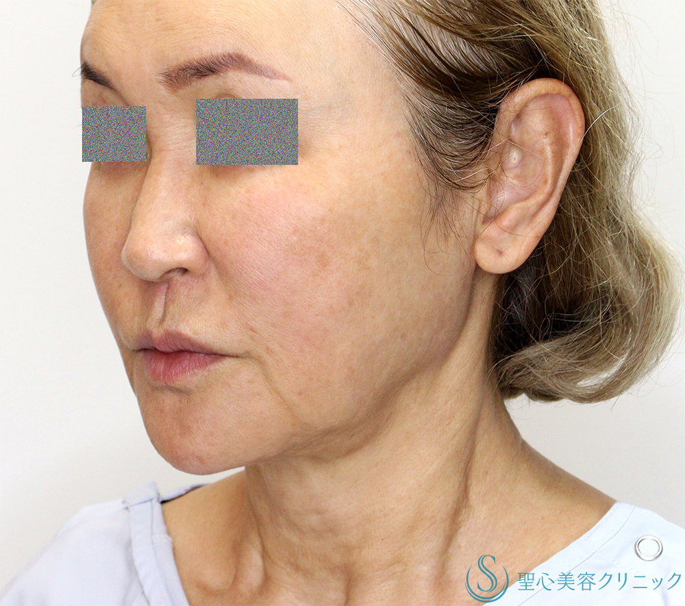 【60代女性・頬～顎下のたるみ・膨らみの改善】フェイスリフト（Low SMAS三角弁法modified）＋ 頬脂肪吸引（1ヶ月後） Before 