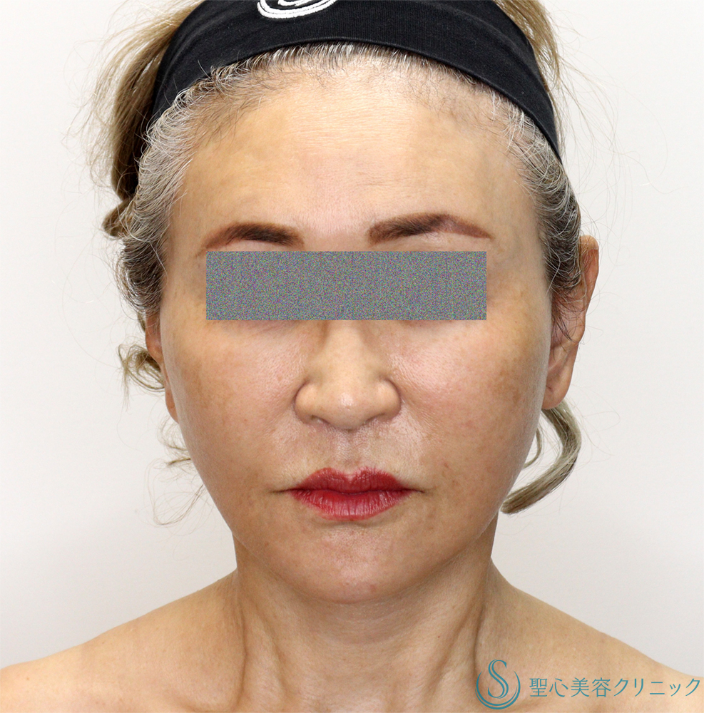 【60代女性・頬～顎下のたるみ・膨らみの改善】フェイスリフト（Low SMAS三角弁法modified）＋ 頬脂肪吸引（1ヶ月後） After 