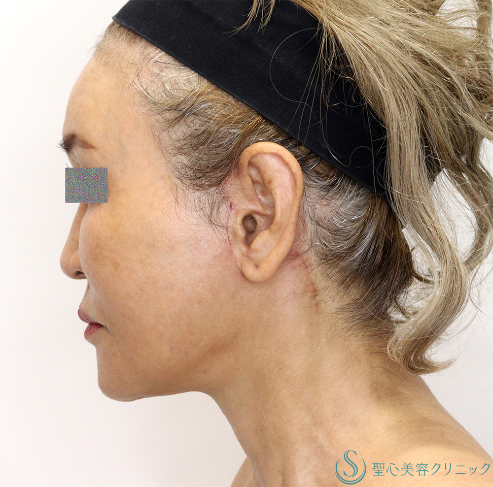 【60代女性・頬～顎下のたるみ・膨らみの改善】フェイスリフト（Low SMAS三角弁法modified）＋ 頬脂肪吸引（1ヶ月後） After 