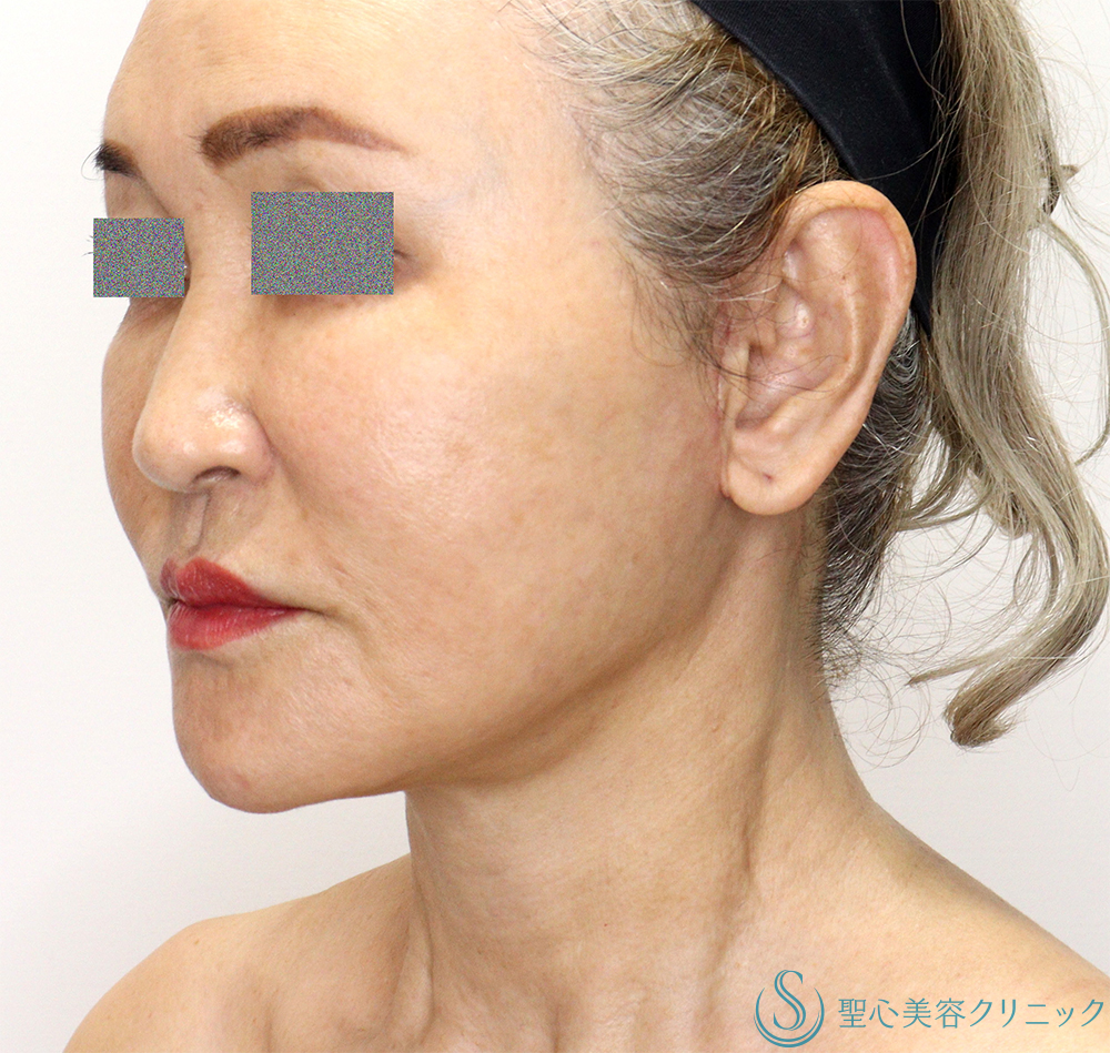 【60代女性・頬～顎下のたるみ・膨らみの改善】フェイスリフト（Low SMAS三角弁法modified）＋ 頬脂肪吸引（1ヶ月後） After 