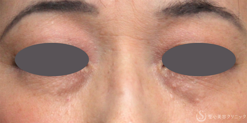 【50代女性・プレミアムPRPの長期経過】プレミアムPRP皮膚再生療法（1年～9年後） Before 名古屋・クマ治療・目の下のたるみ