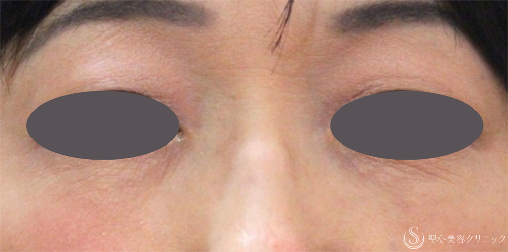 【50代女性・プレミアムPRPの長期経過】プレミアムPRP皮膚再生療法（1年～9年後） After 