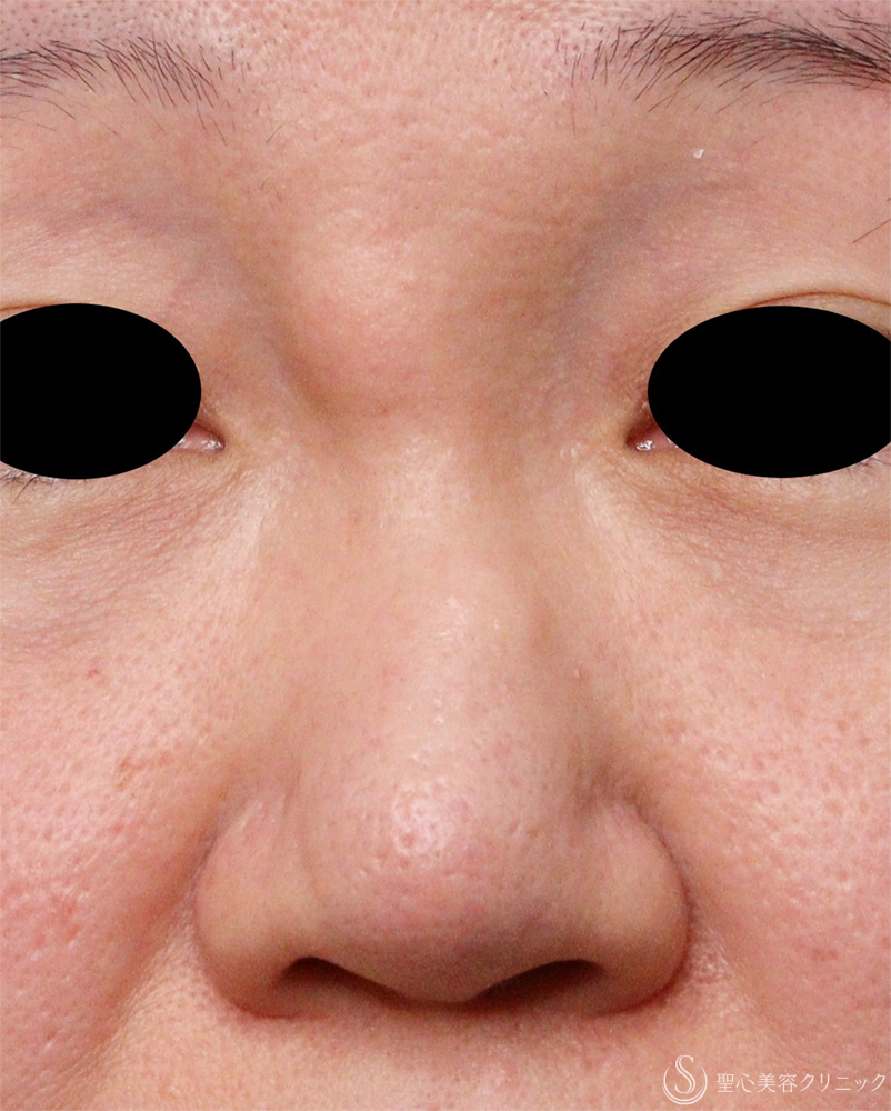 【40代女性・鼻の異物】エンドプロテーゼ取り出し（1週間後） Before 
