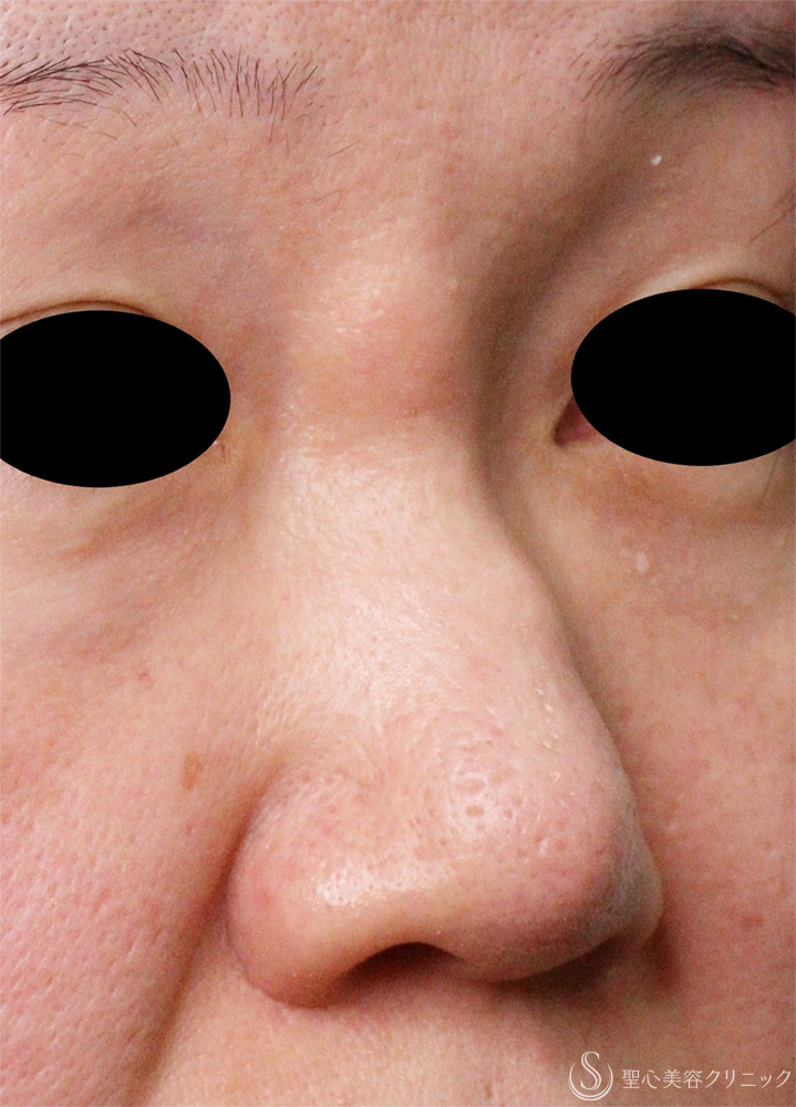 【40代女性・鼻の異物】エンドプロテーゼ取り出し（1週間後） Before 