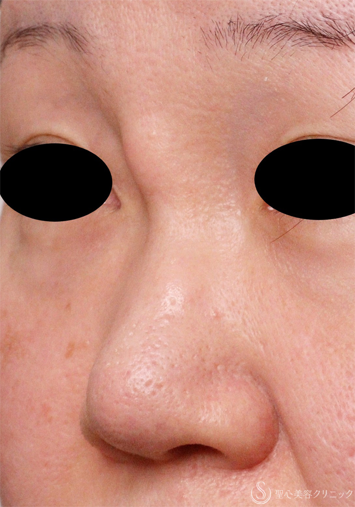 【40代女性・鼻の異物】エンドプロテーゼ取り出し（1週間後） Before 