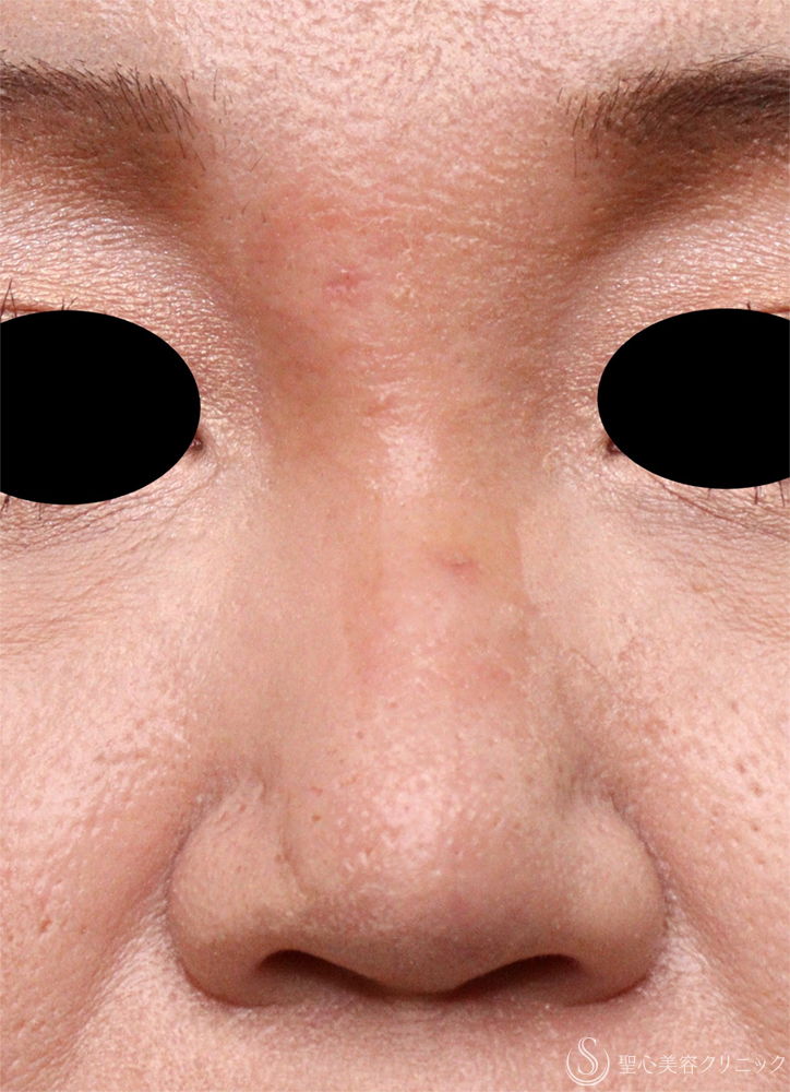 【40代女性・鼻の異物】エンドプロテーゼ取り出し（1週間後） After 