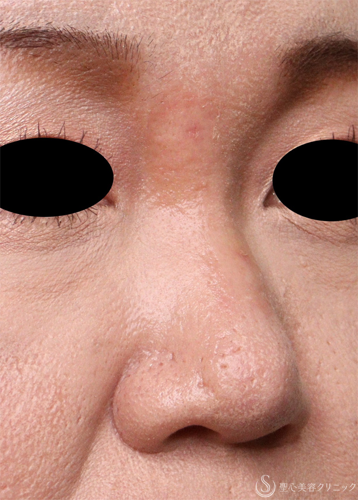 【40代女性・鼻の異物】エンドプロテーゼ取り出し（1週間後） After 