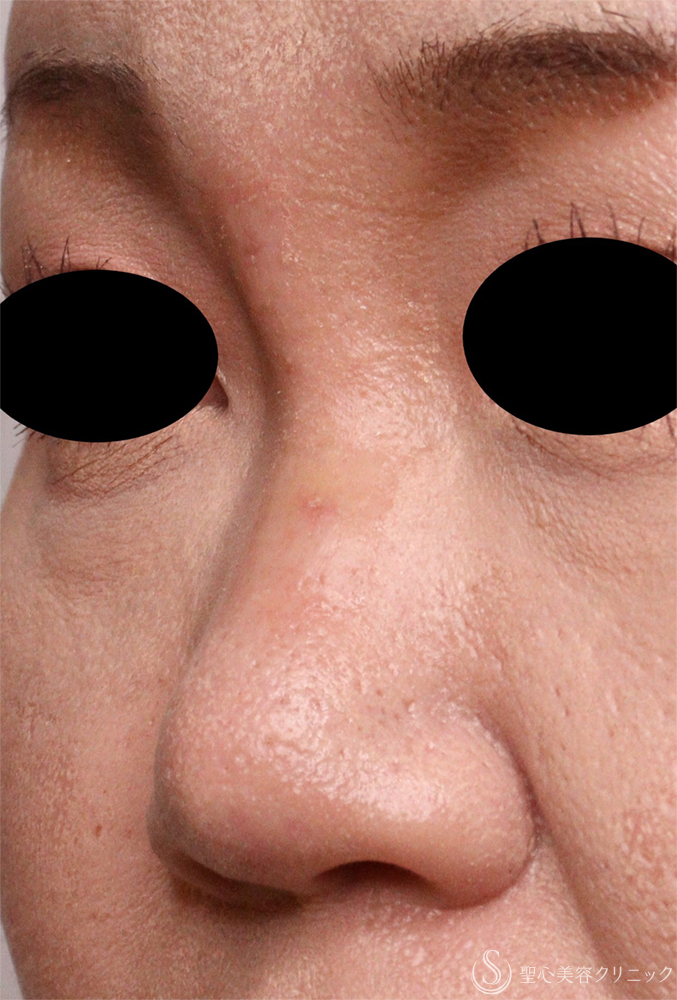 【40代女性・鼻の異物】エンドプロテーゼ取り出し（1週間後） After 