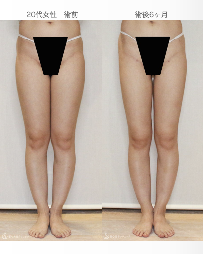 【20代女性・太もも脂肪吸引の実際】ベイザー脂肪吸引（6ヶ月後） After 