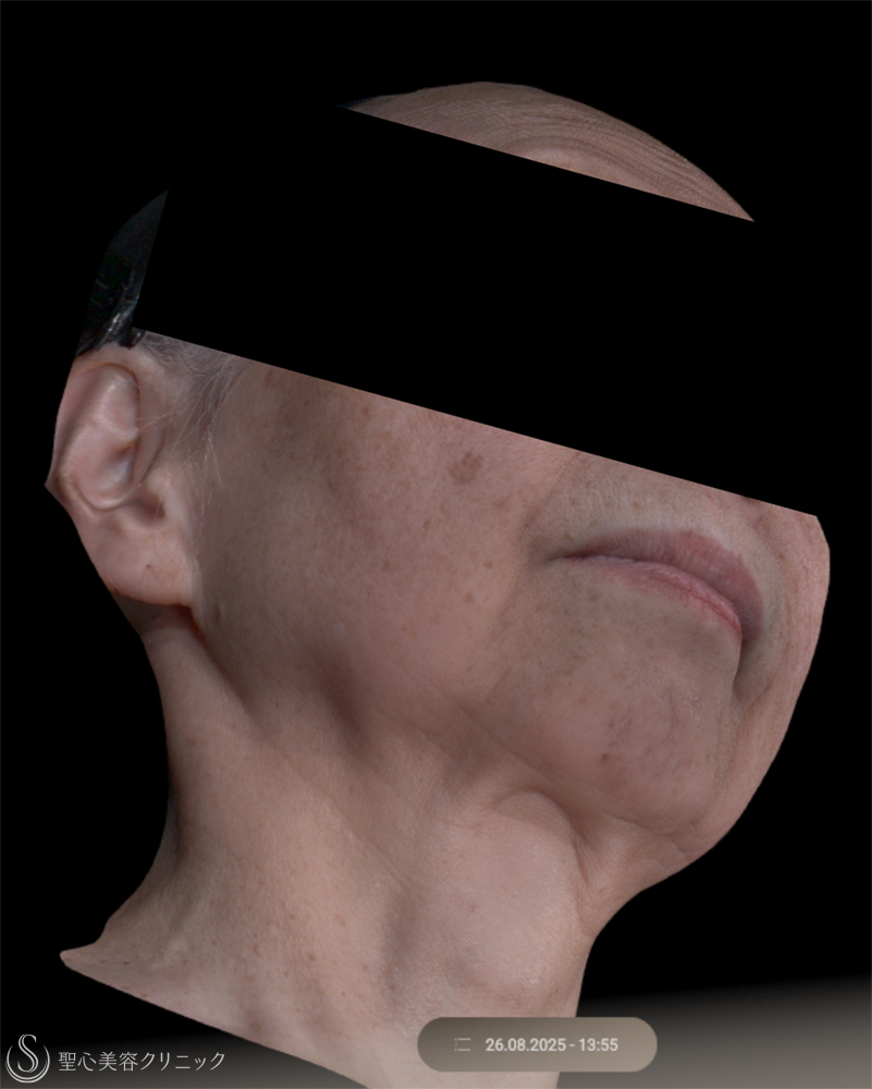 【70代女性・きれいなフェイスラインに】 ヒアルロン酸注入（2ヶ月後） Before 
