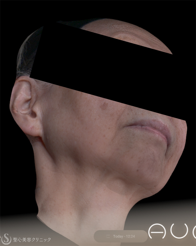 【70代女性・きれいなフェイスラインに】 ヒアルロン酸注入（2ヶ月後） After 