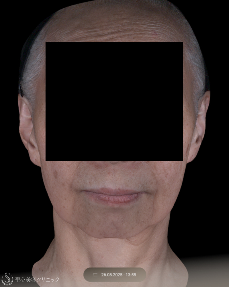 【70代女性・きれいなフェイスラインに】 ヒアルロン酸注入（2ヶ月後） Before 
