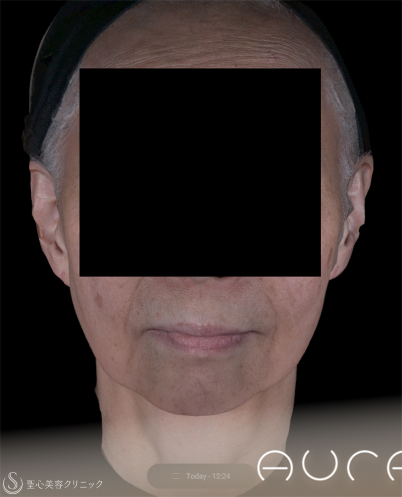 【70代女性・きれいなフェイスラインに】 ヒアルロン酸注入（2ヶ月後） After 