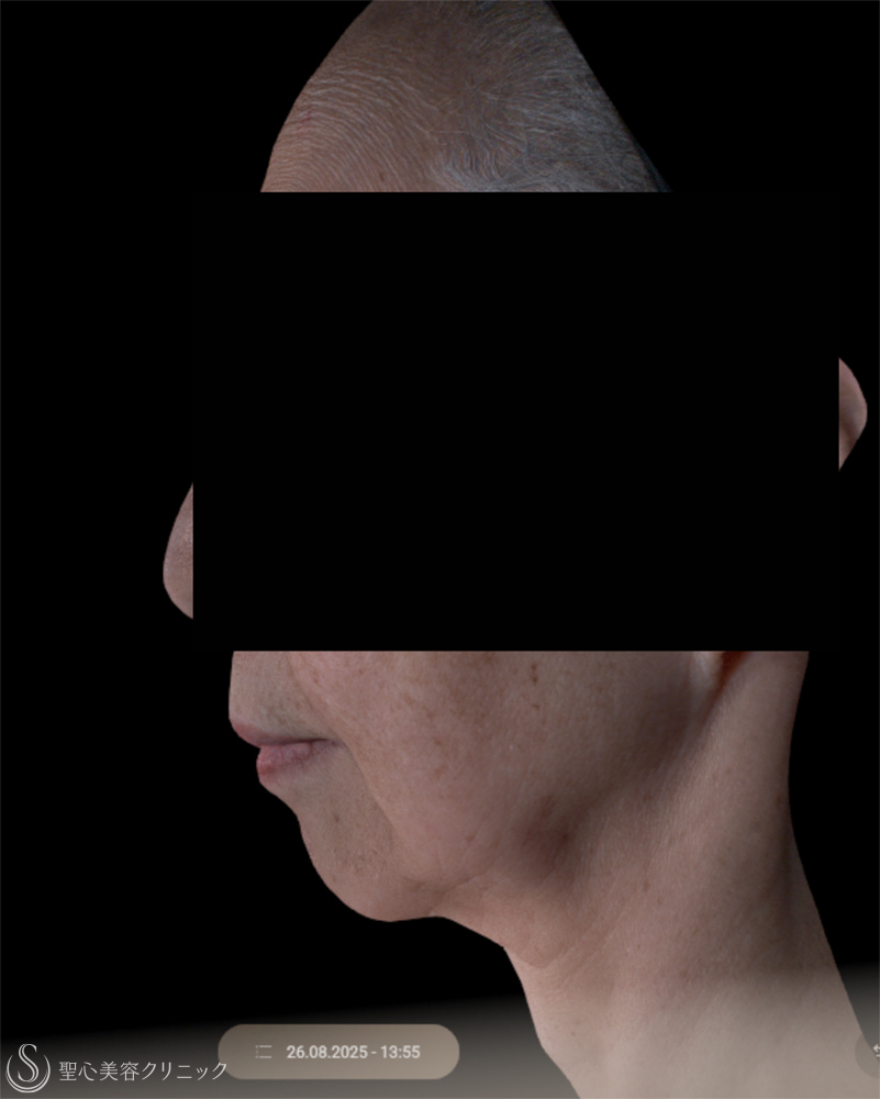 【70代女性・きれいなフェイスラインに】 ヒアルロン酸注入（2ヶ月後） Before 